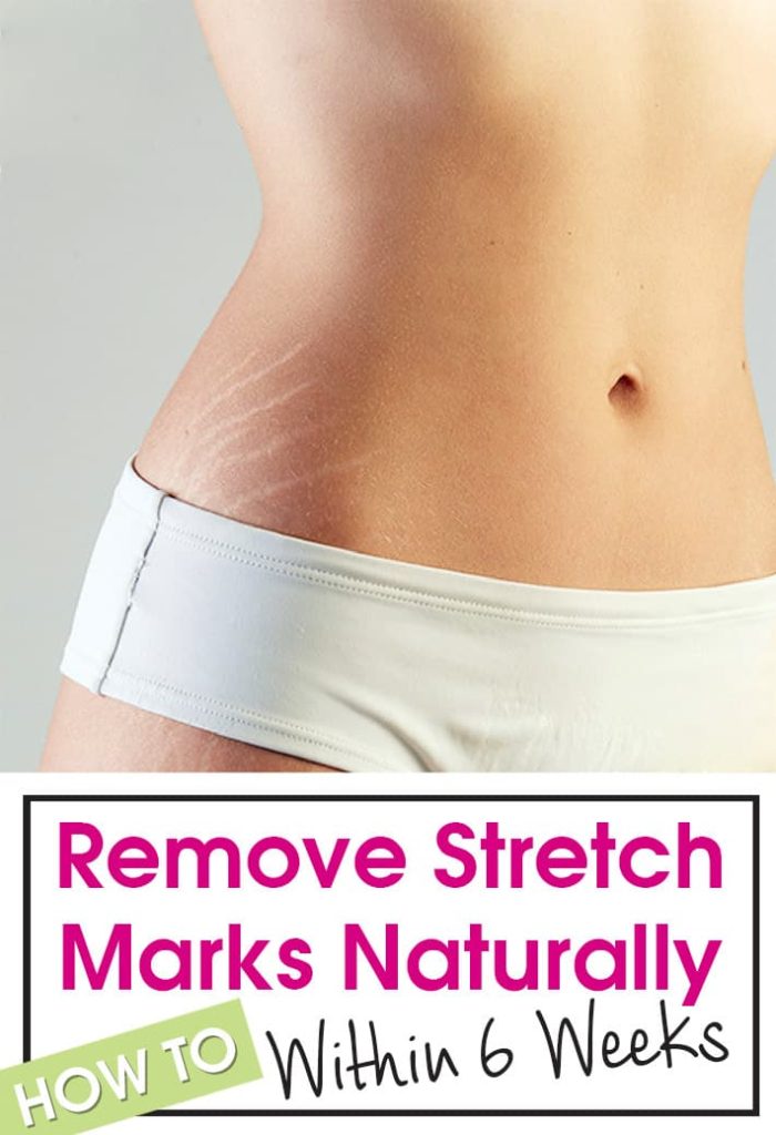 Remove Stretch Marks Naturally Within 6 Weeks.